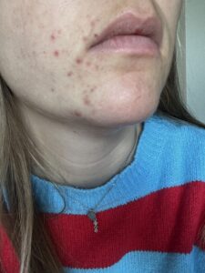 skincare acne 